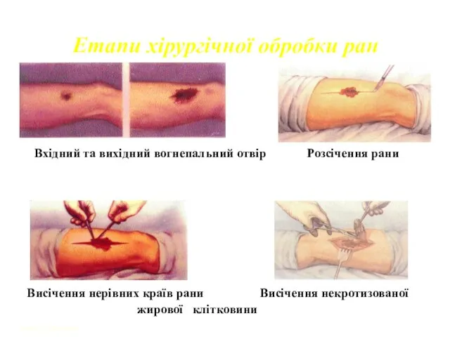 Designed by A. Bondarevskyi Етапи хірургічної обробки ран Вхідний та вихідний вогнепальний