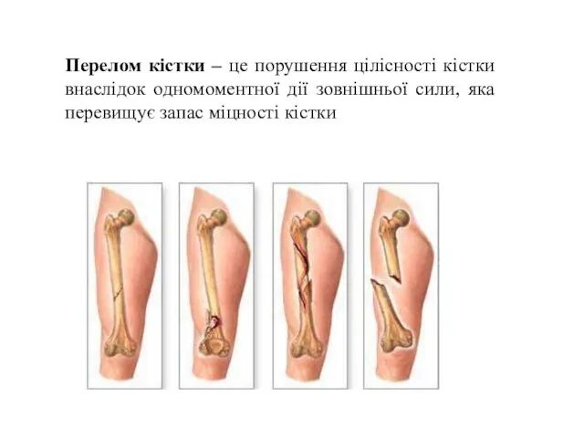 Перелом кістки – це порушення цілісності кістки внаслідок одномоментної дії зовнішньої сили,