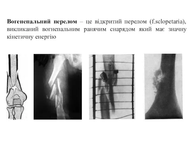 Вогенепальний перелом – це відкритий перелом (f.sclopetaria), викликаний вогнепальним ранячим снарядом який має значну кінетичну енергію