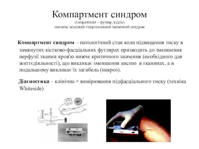 Компартмент синдром (compartment – футляр, відсік) синонім: місцевий гіпертензивний ішемічний синдром Компартмент