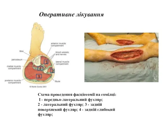 Оперативне лікування Схема проведення фасціотомії на гомілці: І - передньо-латеральний футляр; 2