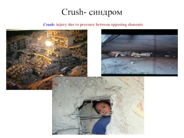Crush- синдром Crush: injury due to pressure between opposing elements