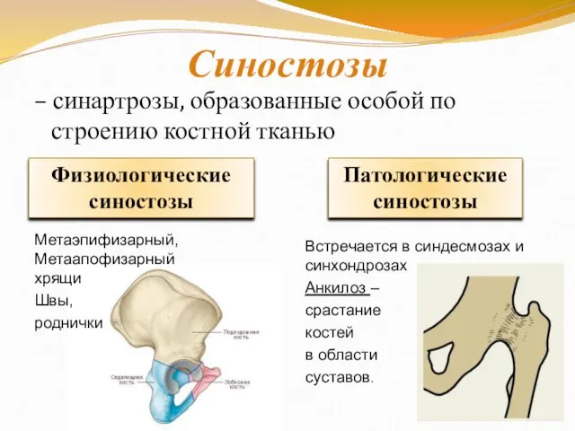 Синостозы – синартрозы, образованные особой по строению костной тканью Физиологические синостозы Патологические