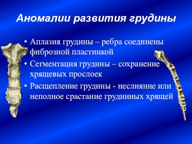 Аномалии развития грудины Аплазия грудины – ребра соединены фиброзной пластинкой Сегментация грудины