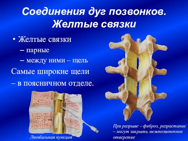 Соединения дуг позвонков. Желтые связки Желтые связки парные между ними – щель