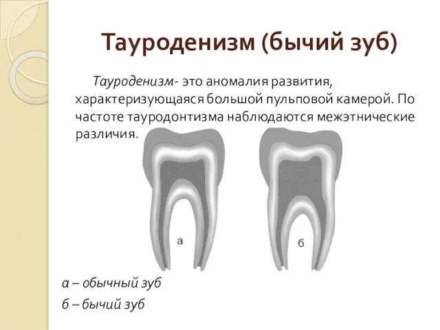 Тауроденизм (бычий зуб) Тауроденизм- это аномалия развития, характеризующаяся большой пульповой камерой. По