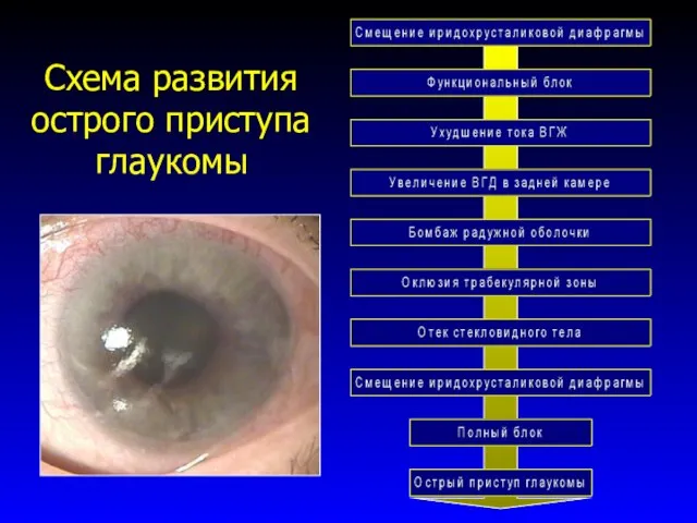 Схема развития острого приступа глаукомы