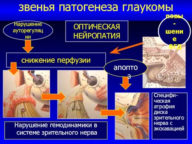 звенья патогенеза глаукомы Специфи- ческая атрофия диска зрительного нерва с экскавацией Нарушение