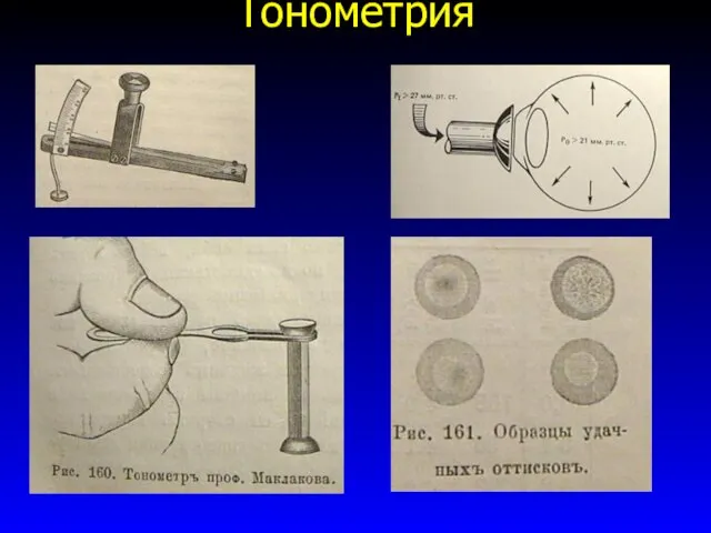 Тонометрия