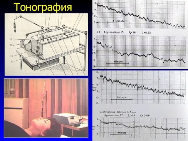 Тонография