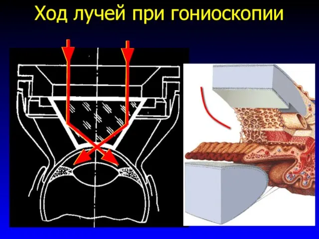 Ход лучей при гониоскопии