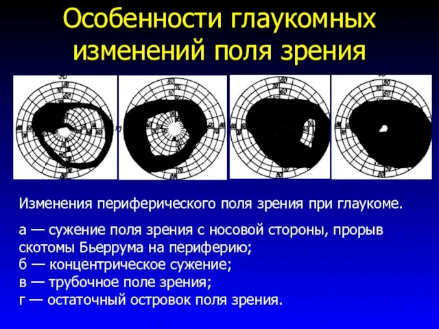 Особенности глаукомных изменений поля зрения Изменения периферического поля зрения при глаукоме. а