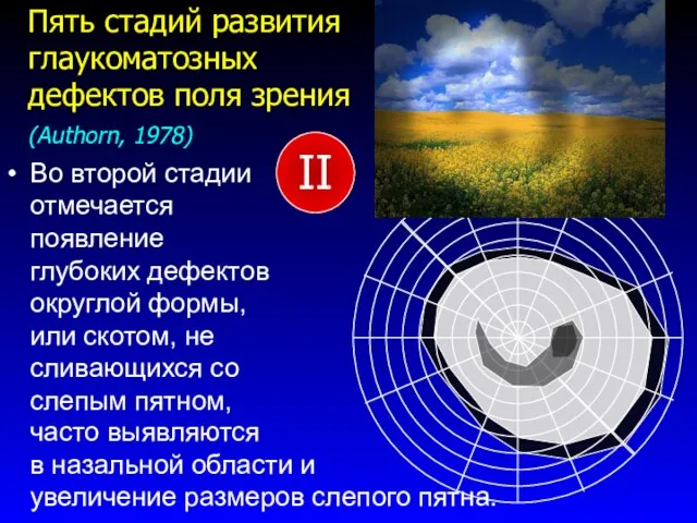 Во второй стадии отмечается появление глубоких дефектов округлой формы, или скотом, не