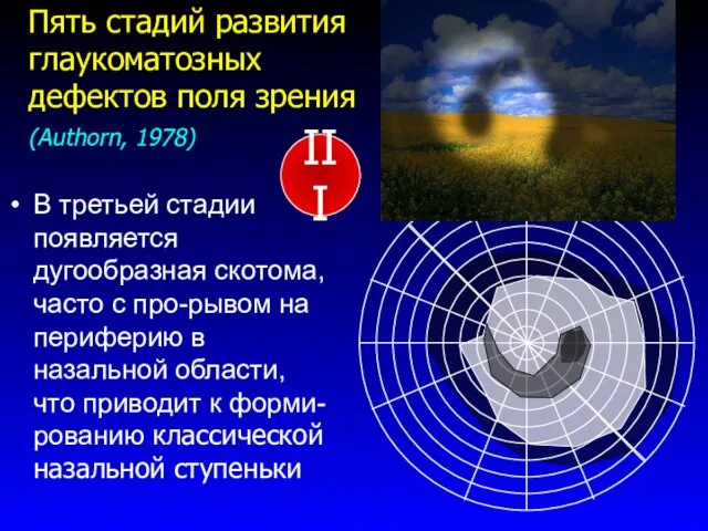 В третьей стадии появляется дугообразная скотома,часто с про-рывом на периферию в назальной