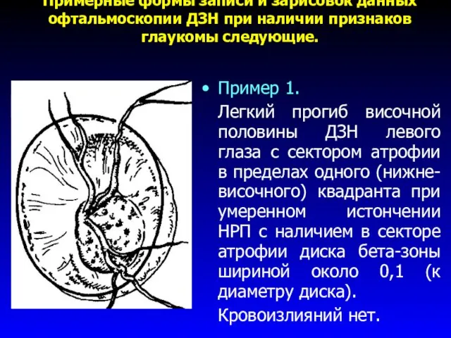 Примерные формы записи и зарисовок данных офтальмоскопии ДЗН при наличии признаков глаукомы