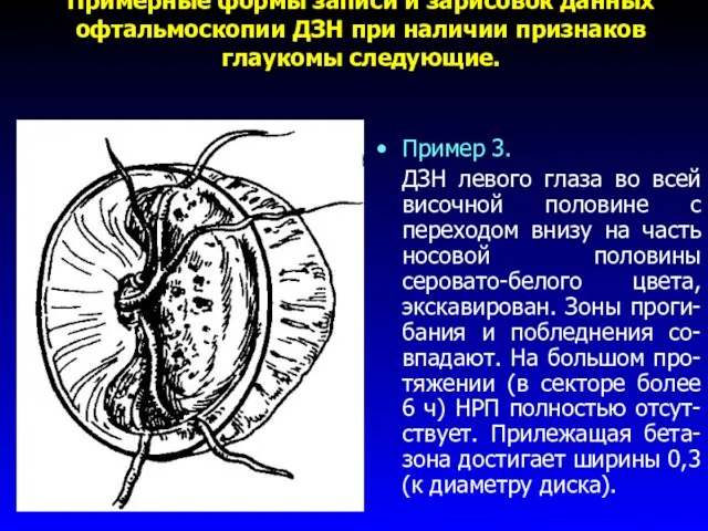 Примерные формы записи и зарисовок данных офтальмоскопии ДЗН при наличии признаков глаукомы