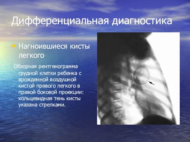 Дифференциальная диагностика Нагноившиеся кисты легкого Обзорная рентгенограмма грудной клетки ребенка с врожденной