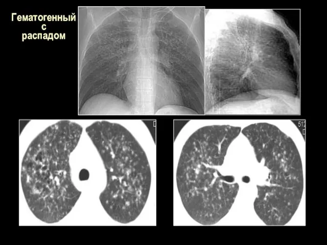 Гематогенный с распадом
