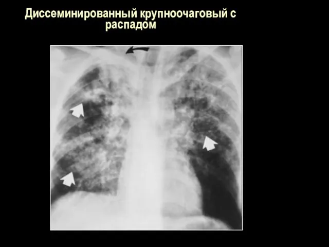 Диссеминированный крупноочаговый с распадом