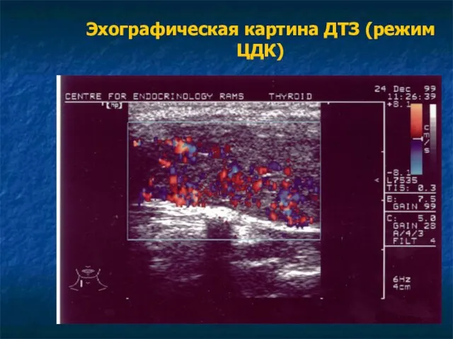 Эхографическая картина ДТЗ (режим ЦДК)