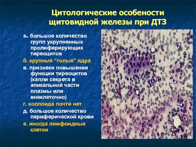 Цитологические особености щитовидной железы при ДТЗ а. большое количество групп укрупненных пролиферирующих