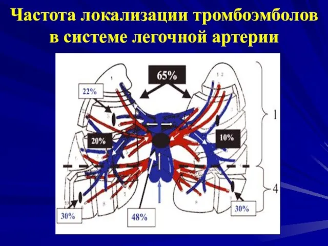 Частота локализации тромбоэмболов в системе легочной артерии