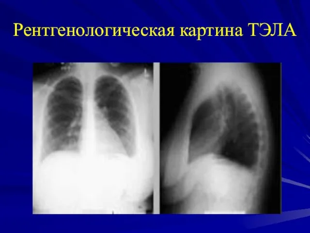 Рентгенологическая картина ТЭЛА