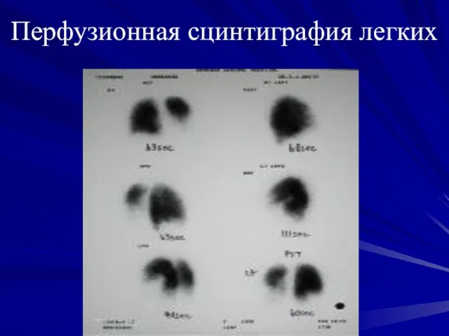 Перфузионная сцинтиграфия легких