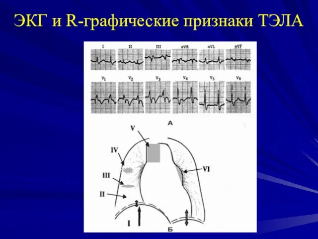 ЭКГ и R-графические признаки ТЭЛА