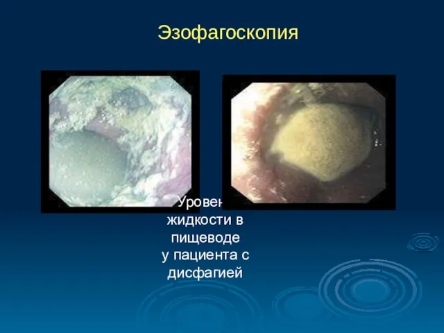 Эзофагоскопия Уровень жидкости в пищеводе у пациента с дисфагией