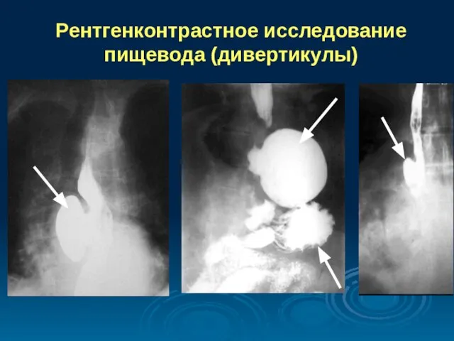 Рентгенконтрастное исследование пищевода (дивертикулы)