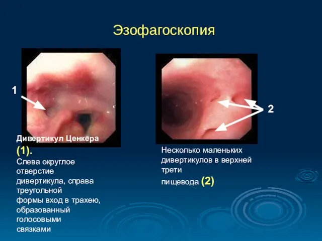 Эзофагоскопия Дивертикул Ценкера (1). Слева округлое отверстие дивертикула, справа треугольной формы вход