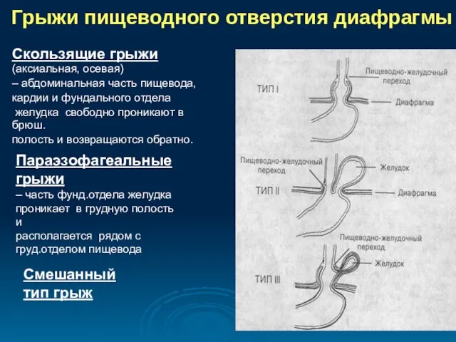 Грыжи пищеводного отверстия диафрагмы Скользящие грыжи (аксиальная, осевая) – абдоминальная часть пищевода,