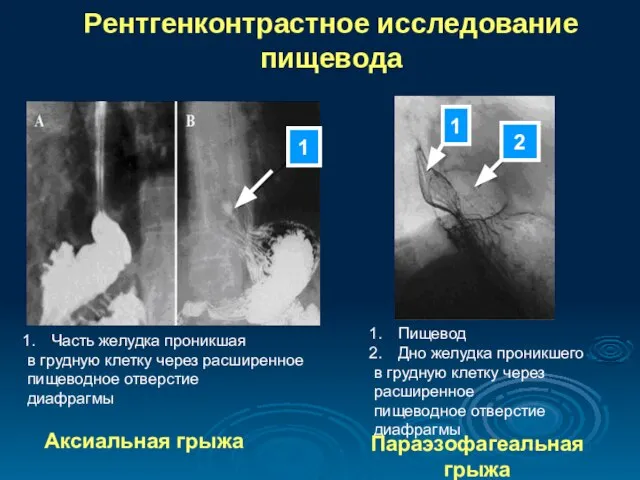 Рентгенконтрастное исследование пищевода Часть желудка проникшая в грудную клетку через расширенное пищеводное