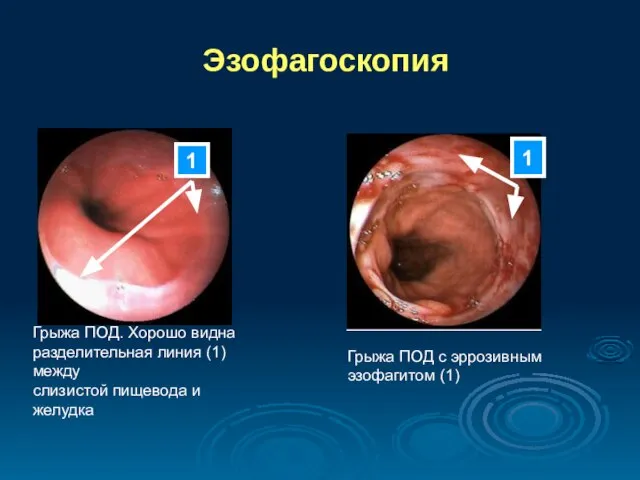 Эзофагоскопия Грыжа ПОД. Хорошо видна разделительная линия (1) между слизистой пищевода и