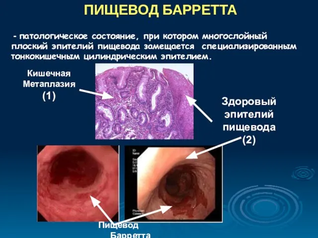 ПИЩЕВОД БАРРЕТТА - патологическое состояние, при котором многослойный плоский эпителий пищевода замещается