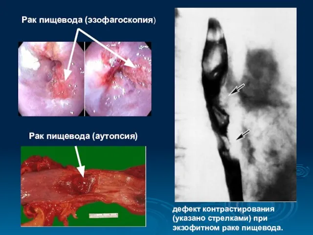 дефект контрастирования (указано стрелками) при экзофитном раке пищевода. Рак пищевода (эзофагоскопия) Рак пищевода (аутопсия)