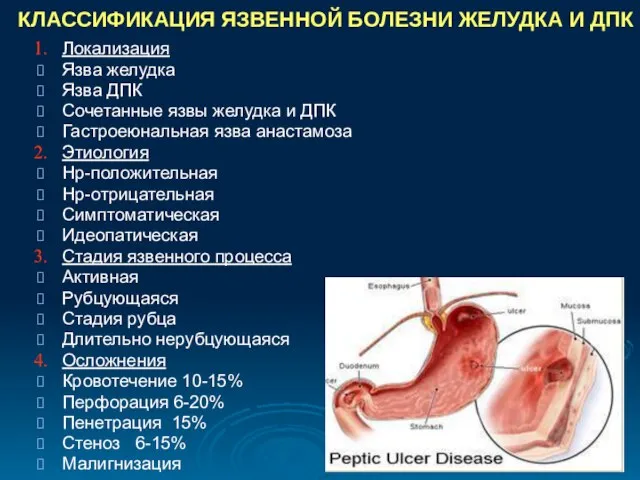 КЛАССИФИКАЦИЯ ЯЗВЕННОЙ БОЛЕЗНИ ЖЕЛУДКА И ДПК Локализация Язва желудка Язва ДПК Сочетанные