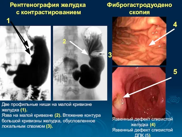 Рентгенография желудка с контрастированием Фиброгастродуоденоскопия Язвенный дефект слизистой желудка (4) Язвенный дефект