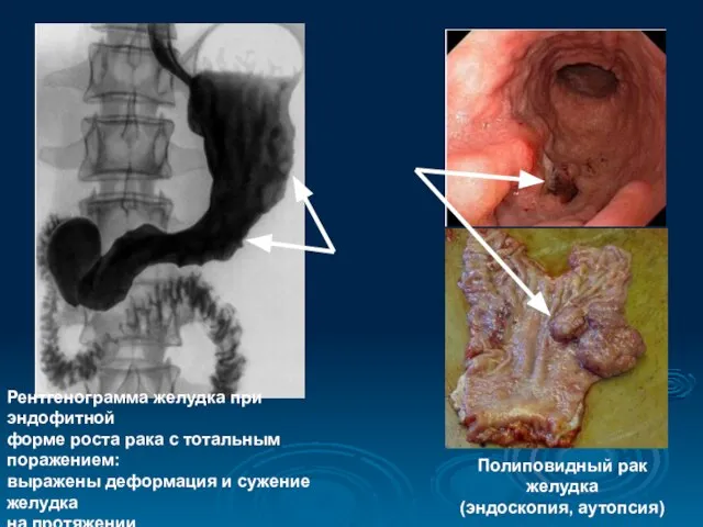 Рентгенограмма желудка при эндофитной форме роста рака с тотальным поражением: выражены деформация