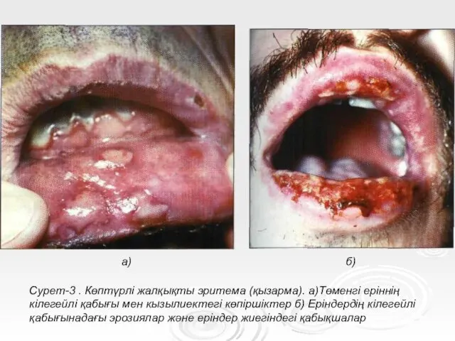 Сурет-3 . Көптүрлі жалқықты эритема (қызарма). а)Төменгі еріннің кілегейлі қабығы мен кызылиектегі