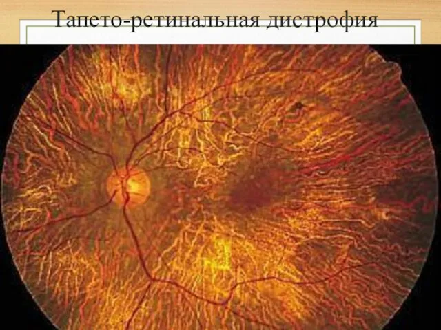 Тапето-ретинальная дистрофия