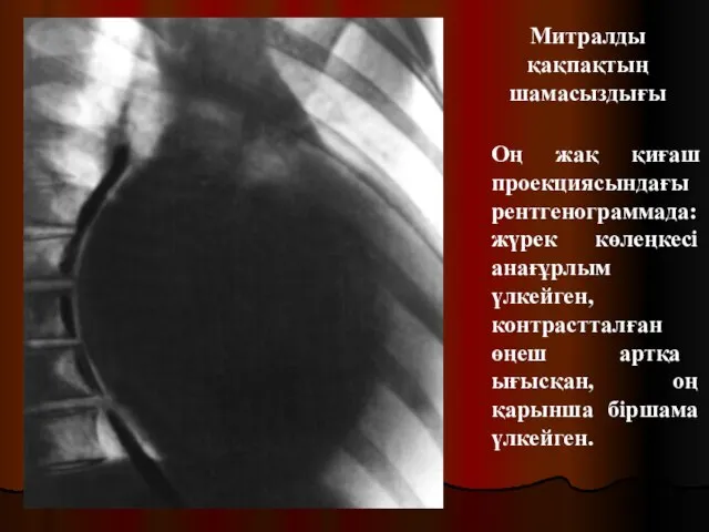 Митралды қақпақтың шамасыздығы Оң жақ қиғаш проекциясындағы рентгенограммада: жүрек көлеңкесі анағұрлым үлкейген,