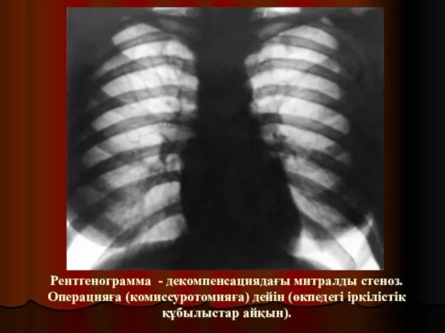 Рентгенограмма - декомпенсациядағы митралды стеноз. Операцияға (комиссуротомияға) дейін (өкпедегі іркілістік құбылыстар айқын).