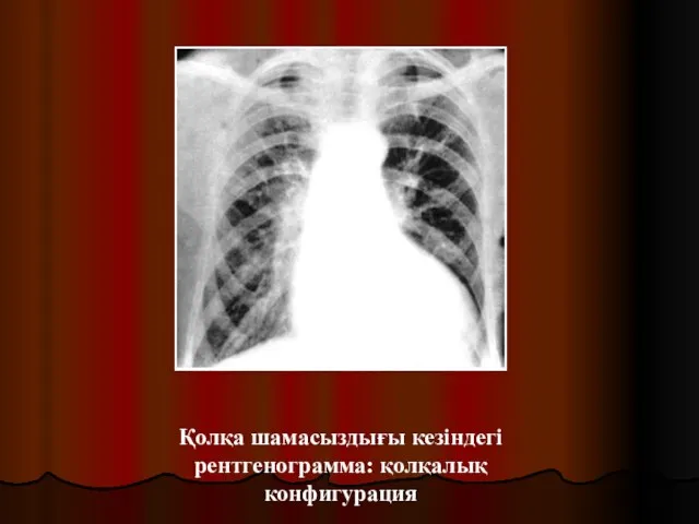 Қолқа шамасыздығы кезіндегі рентгенограмма: қолқалық конфигурация