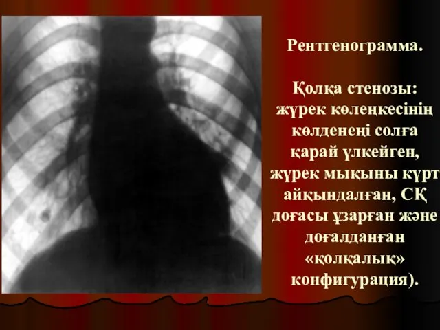 Рентгенограмма. Қолқа стенозы: жүрек көлеңкесінің көлденеңі солға қарай үлкейген, жүрек мықыны күрт