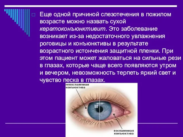 Еще одной причиной слезотечения в пожилом возрасте можно назвать сухой кератоконъюнктивит. Это