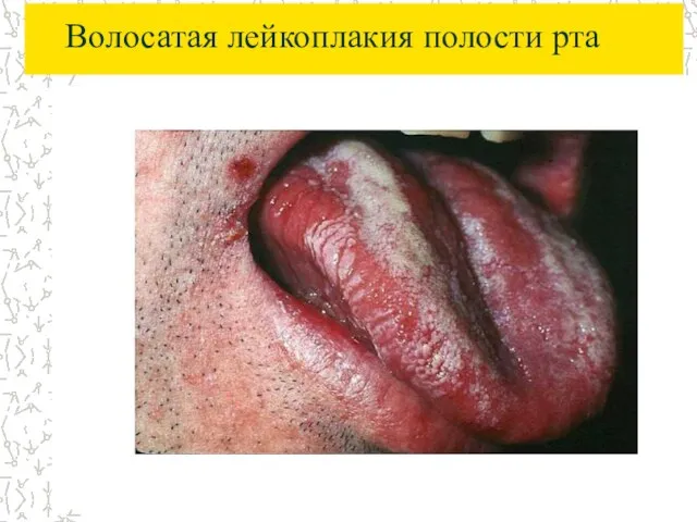 Волосатая лейкоплакия полости рта