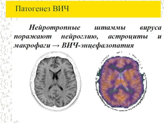 Патогенез ВИЧ