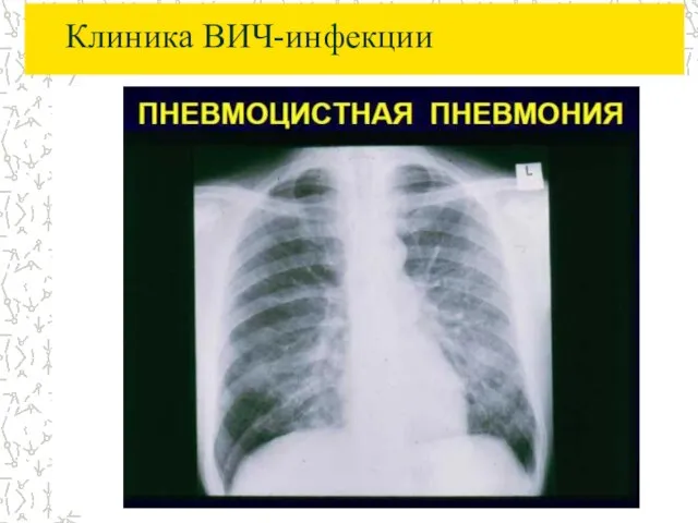 Клиника ВИЧ-инфекции